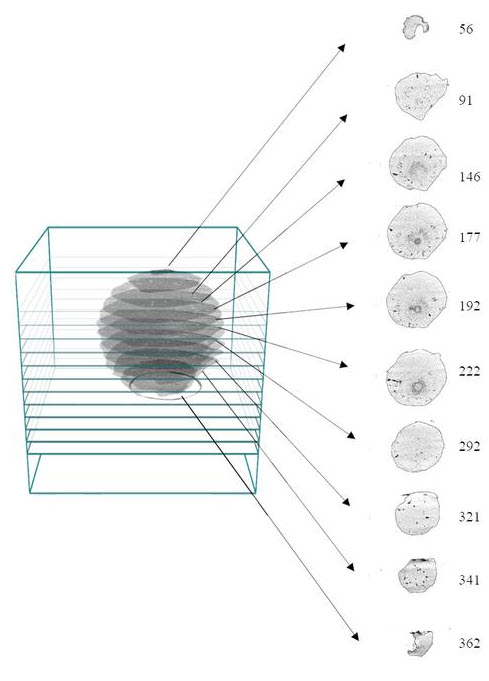 Giant Hailstones CT Scan